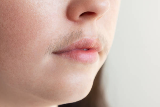 ಹುಡುಗರಂತೆ Beard, mustache ಬರುತ್ತಾ? ಈ ಸಮಸ್ಯೆ ತಡೆಯಲು ಇಲ್ಲಿದೆ Doctor’s advice