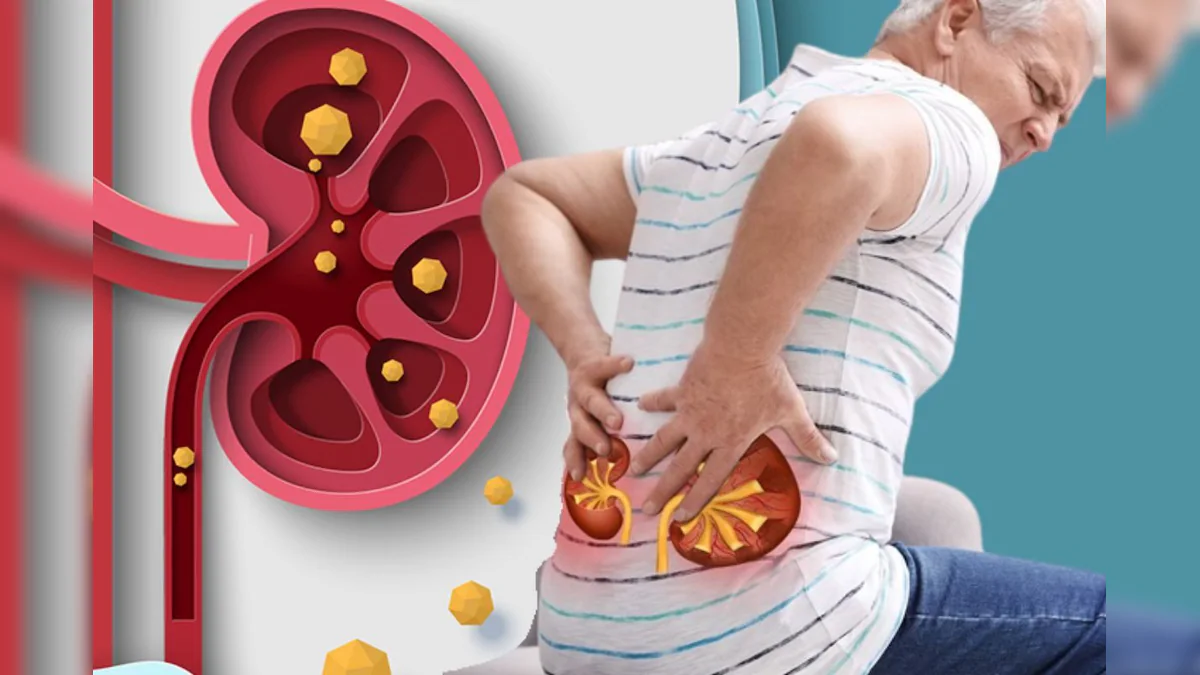 ಚಳಿಗಾಲದಲ್ಲಿ ಕಿಡ್ನಿ ಸ್ಟೋನ್ ಏಕೆ ಹೆಚ್ಚುತ್ತದೆ? ವೈದ್ಯರ ಎಚ್ಚರಿಕೆ.