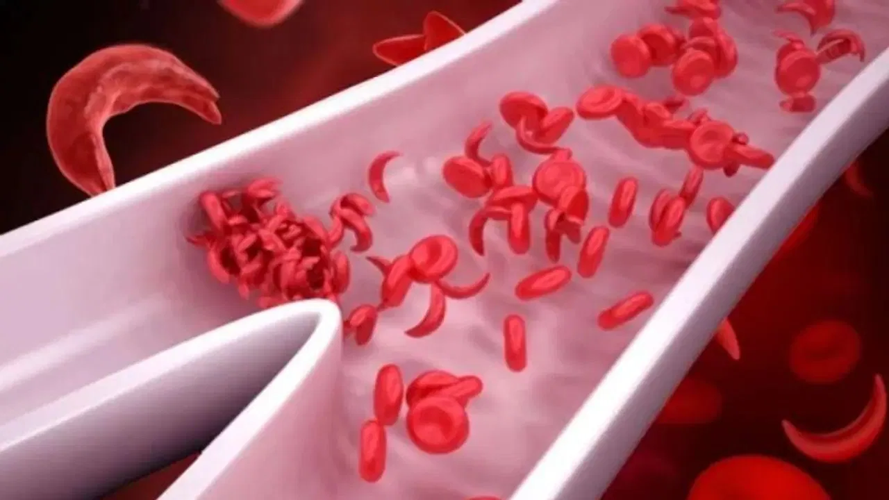  ಧಾರವಾಡದಲ್ಲಿ ಅರ್ಧ ಲಕ್ಷಕ್ಕೂ ಹೆಚ್ಚು ಮಕ್ಕಳು ರಕ್ತಹೀನತೆ.