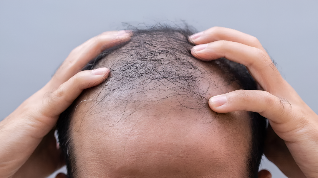 ಸಿಹಿ ಪಾನೀಯಗಳು ಕೂದಲು ಉದುರುವಿಕೆಯ ಕಾರಣ?