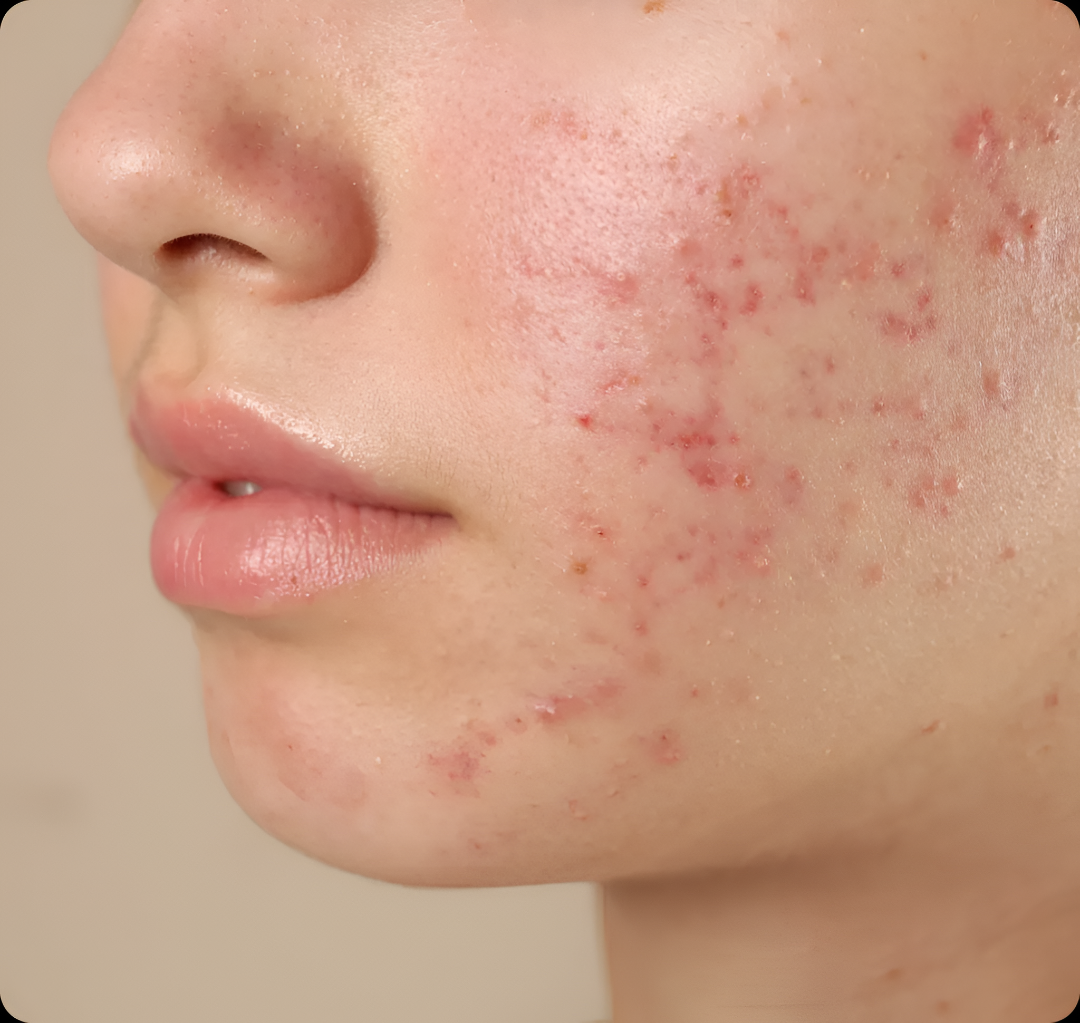 ಮೊಡವೆ ಹೆಚ್ಚಾಗಲು ಕಾರಣವೇನು? ತಡೆಯಲು ಈ ಸುಲಭ ಟಿಪ್ಸ್ ಅನುಸರಿಸಿ.