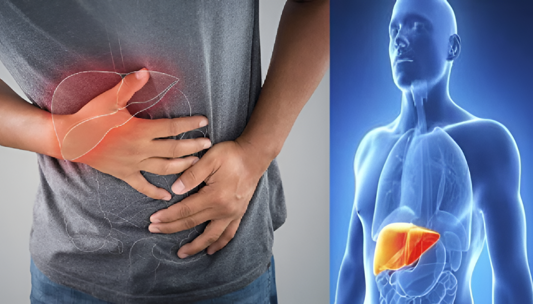 ಫ್ಯಾಟಿ ಲಿವರ್ ತಡೆಯಲು ಎಣ್ಣೆ, ತುಪ್ಪ ತ್ಯಜಿಸಬೇಕೇ?