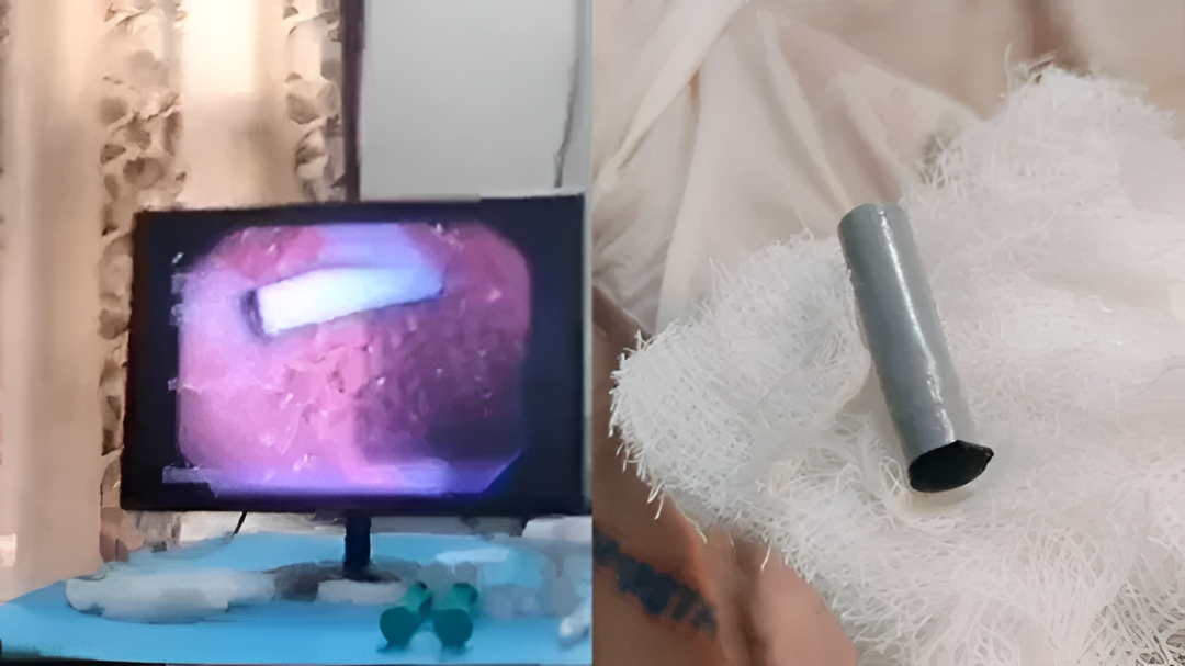 ಪೆನ್ ಕ್ಯಾಪ್ ನುಂಗಿದ ಬಾಲಕನ ಜೀವ ಉಳಿಸಿದ ವೈದ್ಯರು.