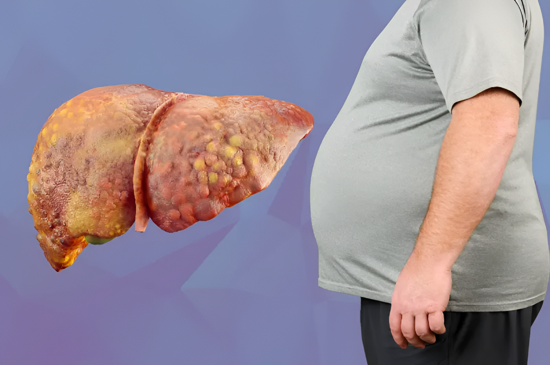 Fatty liver: ಸಮಯಕ್ಕೆ ತಿಳಿದುಕೊಂಡರೆ ಮಾತ್ರ ಅಪಾಯ ತಪ್ಪಿಸಬಹುದು.