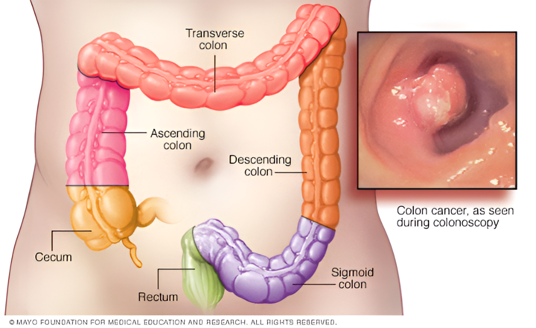 Colon cancer : ಮೌನವಾಗಿ ಬರುತ್ತದೆ, ಆದರೆ ಅಪಾಯಕಾರಿ.!